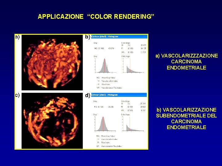 APPLICAZIONE “COLOR RENDERING” a) VASCOLARIZZZAZIONE CARCINOMA ENDOMETRIALE b) VASCOLARIZZAZIONE SUBENDOMETRIALE DEL CARCINOMA ENDOMETRIALE 