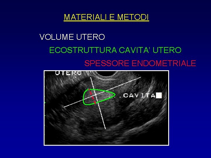 MATERIALI E METODI VOLUME UTERO ECOSTRUTTURA CAVITA’ UTERO SPESSORE ENDOMETRIALE 