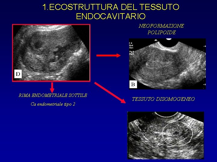 1. ECOSTRUTTURA DEL TESSUTO ENDOCAVITARIO NEOFORMAZIONE POLIPOIDE RIMA ENDOMETRIALE SOTTILE Ca endometriale tipo 2