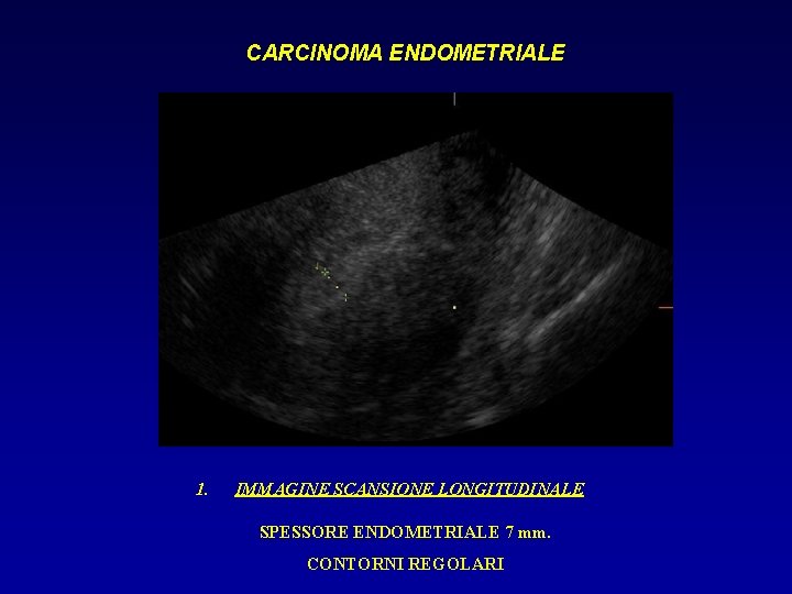 CARCINOMA ENDOMETRIALE 1. IMMAGINE SCANSIONE LONGITUDINALE SPESSORE ENDOMETRIALE 7 mm. CONTORNI REGOLARI 