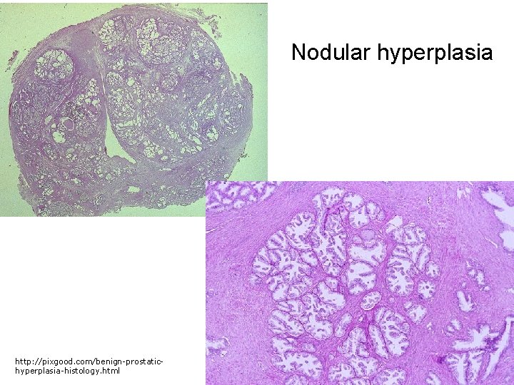 Nodular hyperplasia http: //pixgood. com/benign-prostatichyperplasia-histology. html 