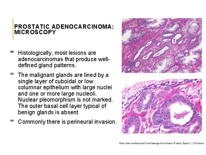 PROSTATIC ADENOCARCINOMA: MICROSCOPY Histologically, most lesions are adenocarcinomas that produce welldefined gland patterns. The