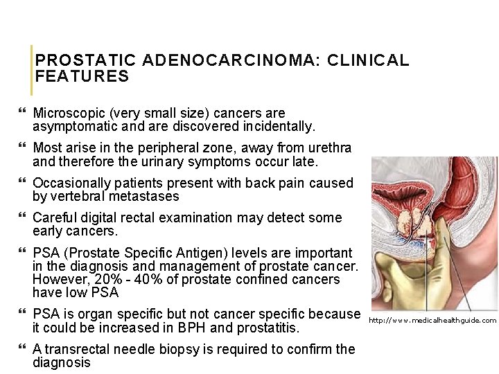 PROSTATIC ADENOCARCINOMA: CLINICAL FEATURES Microscopic (very small size) cancers are asymptomatic and are discovered