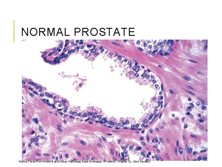 NORMAL PROSTATE Picture Taken from Robbins and Cotran Pathologic basis of disease. 8 th