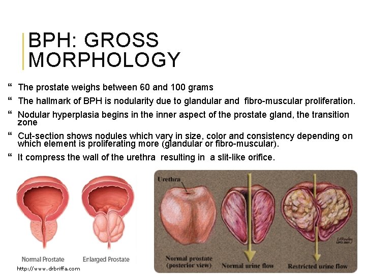 BPH: GROSS MORPHOLOGY The prostate weighs between 60 and 100 grams The hallmark of