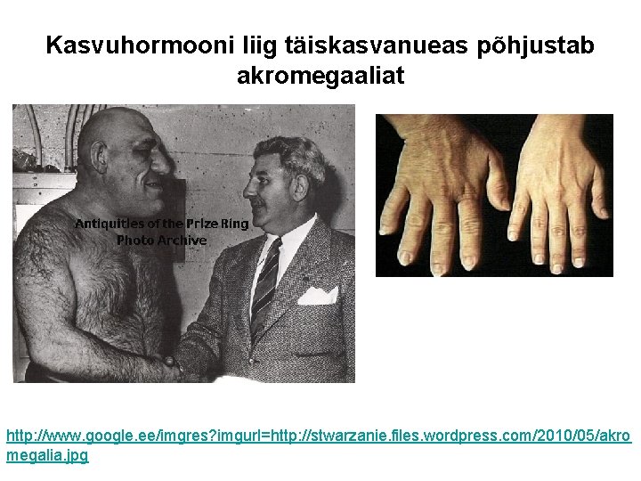 Kasvuhormooni liig täiskasvanueas põhjustab akromegaaliat http: //www. google. ee/imgres? imgurl=http: //stwarzanie. files. wordpress. com/2010/05/akro