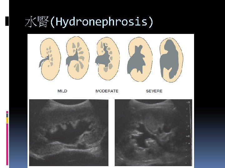 水腎(Hydronephrosis) 