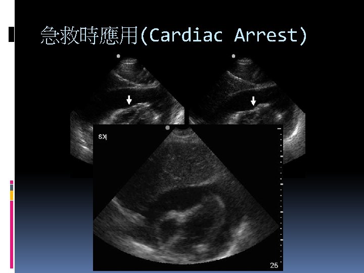 急救時應用(Cardiac Arrest) 