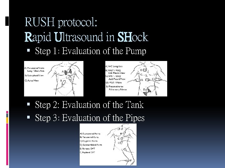 RUSH protocol: Rapid Ultrasound in SHock Step 1: Evaluation of the Pump Step 2: