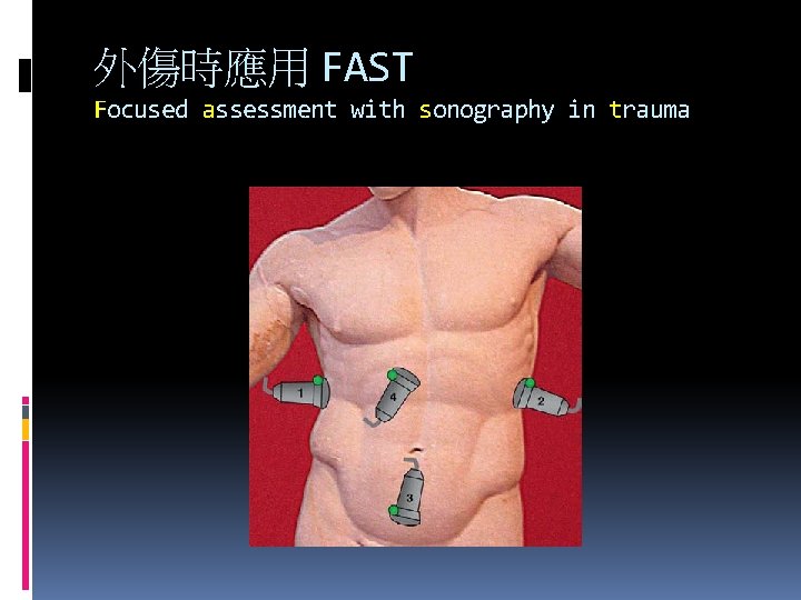 外傷時應用 FAST Focused assessment with sonography in trauma 