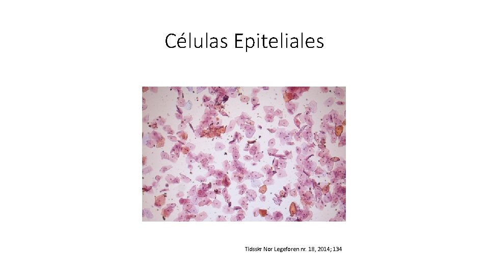 Células Epiteliales Tidsskr Nor Legeforen nr. 18, 2014; 134 