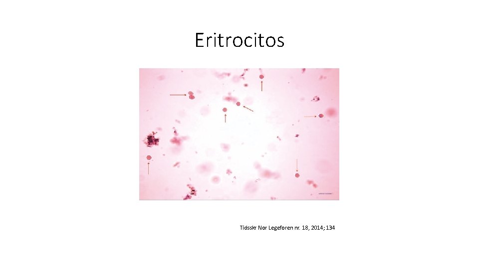 Eritrocitos Tidsskr Nor Legeforen nr. 18, 2014; 134 