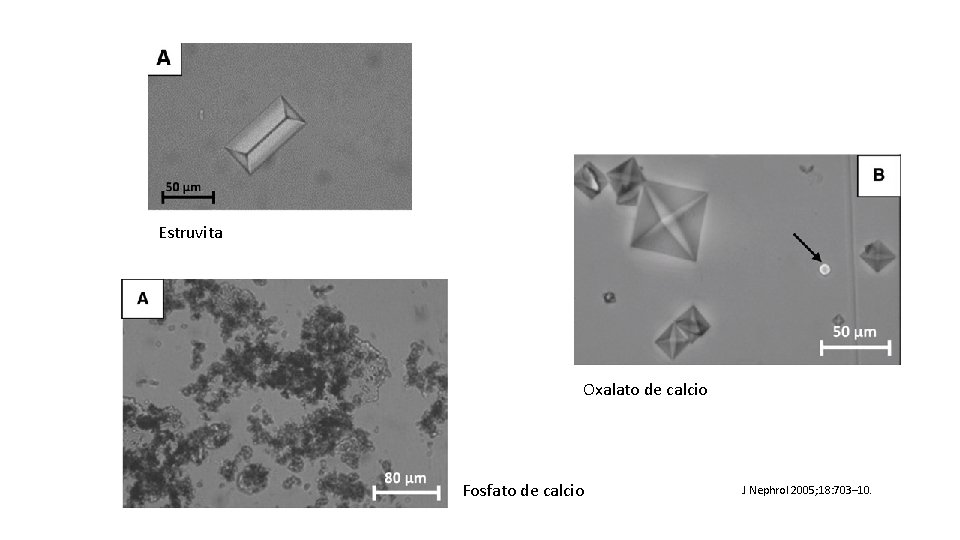 Estruvita Oxalato de calcio Fosfato de calcio J Nephrol 2005; 18: 703– 10. 