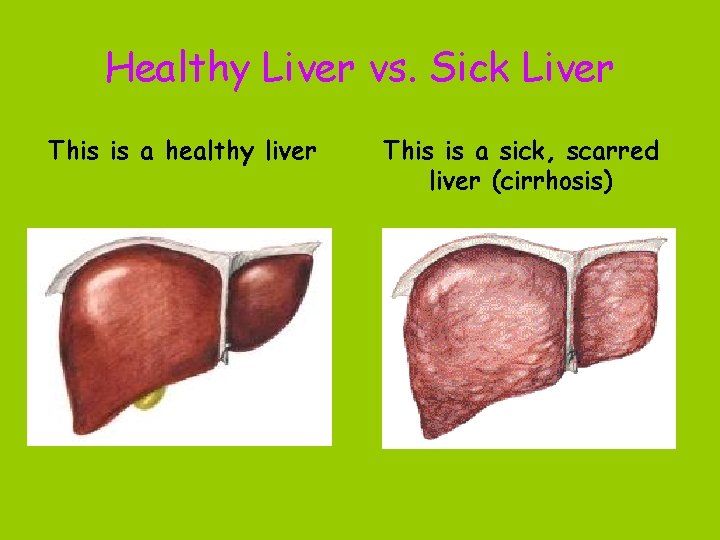 Healthy Liver vs. Sick Liver This is a healthy liver This is a sick,