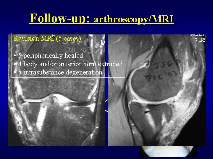 Follow-up: arthroscopy/MRI Revision MRI (5 cases) • 5 peripherically healed • 4 body and/or