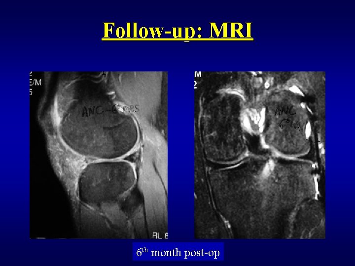 Follow-up: MRI 6 th month post-op 
