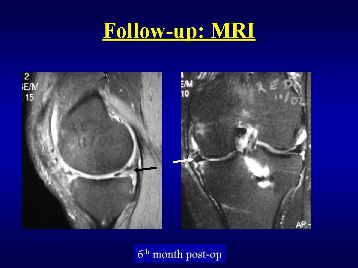 Follow-up: MRI 6 th month post-op 