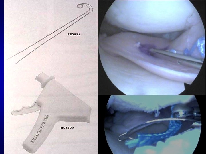 OUR SURGICAL TECHNIQUE • • • With or without bone plugs (? ) Peripheral
