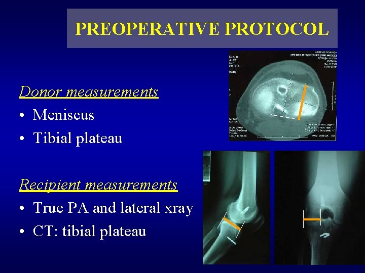 PREOPERATIVE PROTOCOL Donor measurements • Meniscus • Tibial plateau Recipient measurements • True PA