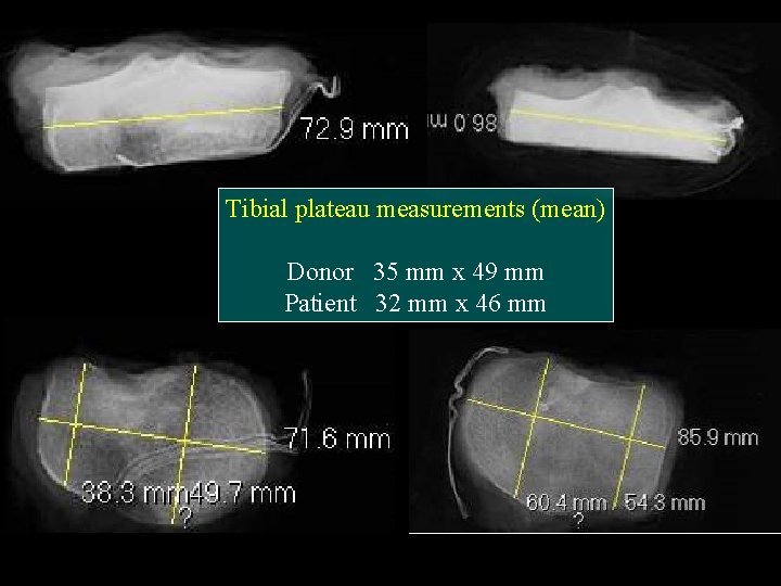 Tibial plateau measurements (mean) Donor 35 mm x 49 mm Patient 32 mm x