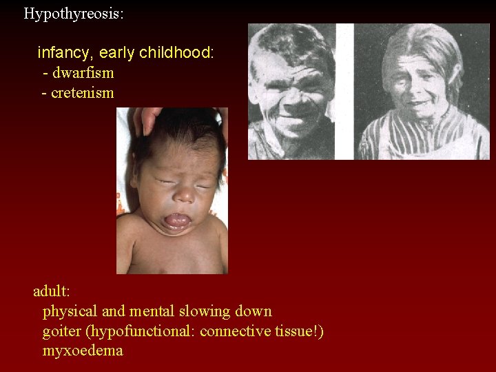 Hypothyreosis: infancy, early childhood: - dwarfism - cretenism adult: physical and mental slowing down
