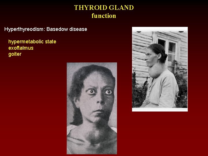 THYROID GLAND function Hyperthyreodism: Basedow disease hypermetabolic state exoftalmus goiter 