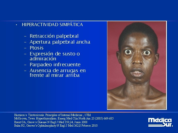  • HIPERACTIVIDAD SIMPÁTICA – – Retracción palpebral Apertura palpebral ancha Ptosis Expresión de