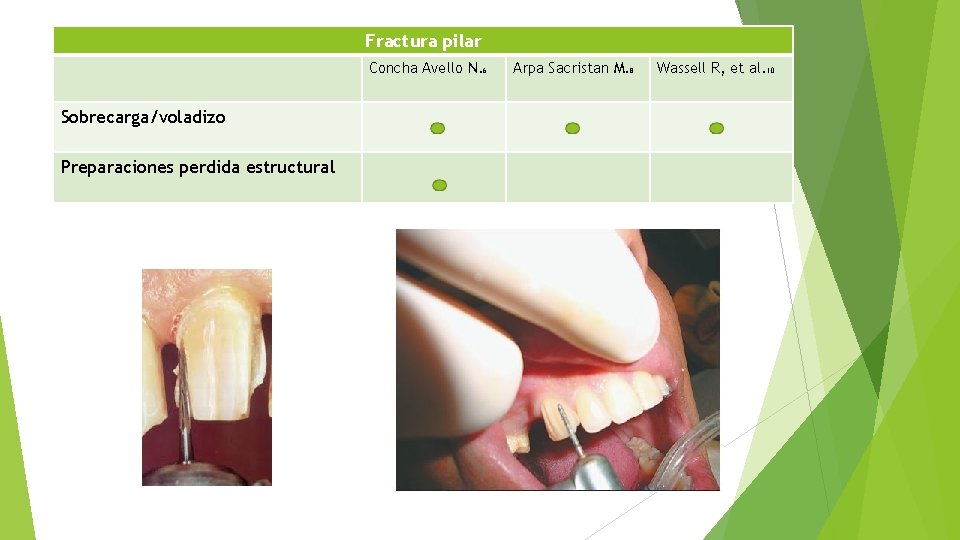 Fractura pilar Concha Avello N. 6 Sobrecarga/voladizo Preparaciones perdida estructural Arpa Sacristan M. 8