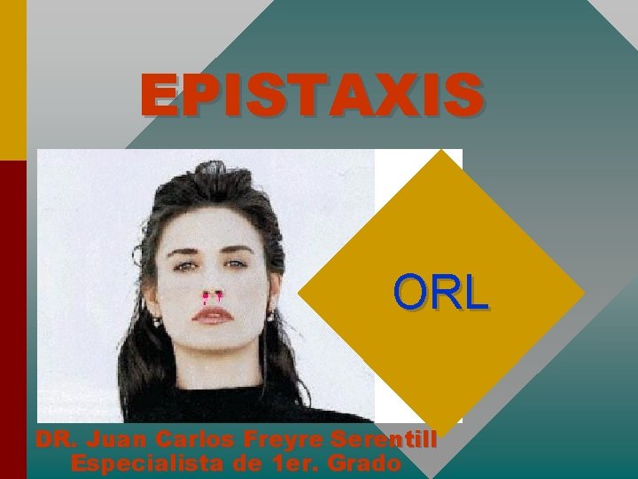 EPISTAXIS ORL DR. Juan Carlos Freyre Serentill Especialista de 1 er. Grado 