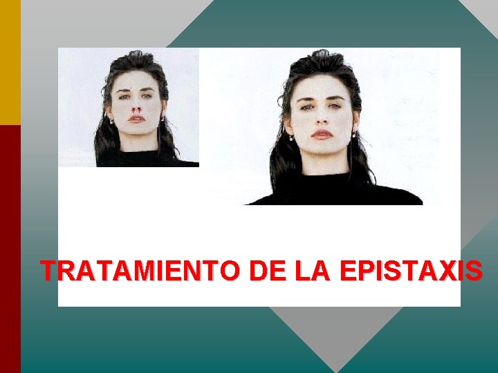 TRATAMIENTO DE LA EPISTAXIS 