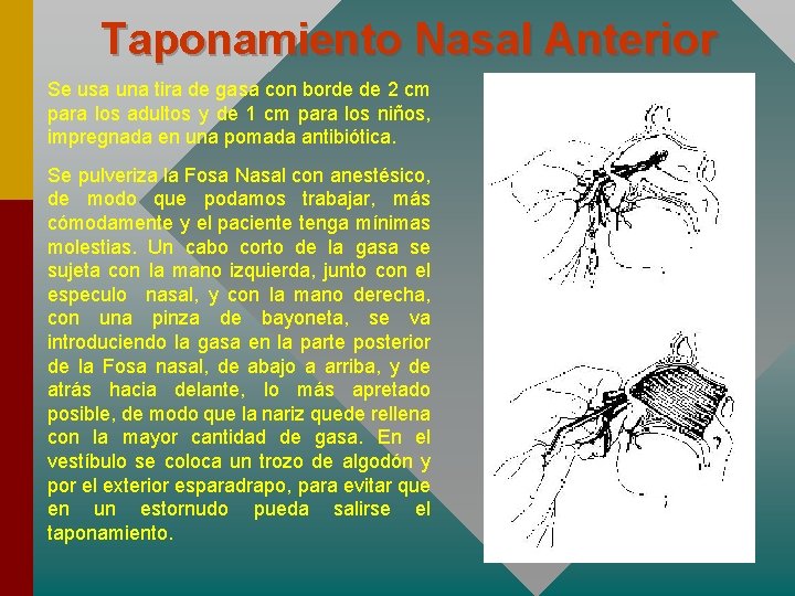 Taponamiento Nasal Anterior Se usa una tira de gasa con borde de 2 cm