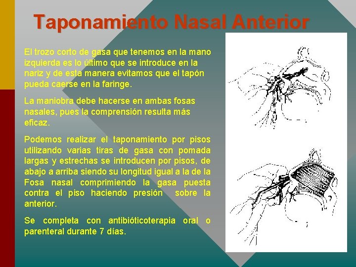 Taponamiento Nasal Anterior El trozo corto de gasa que tenemos en la mano izquierda