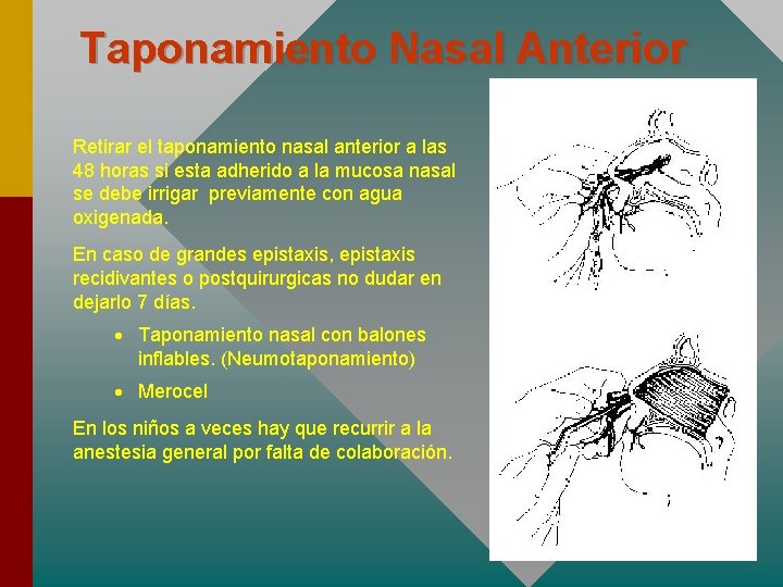 Taponamiento Nasal Anterior Retirar el taponamiento nasal anterior a las 48 horas si esta