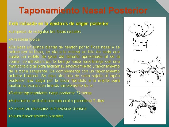 Taponamiento Nasal Posterior Está indicado en la epistaxis de origen posterior ·Limpieza de coágulos