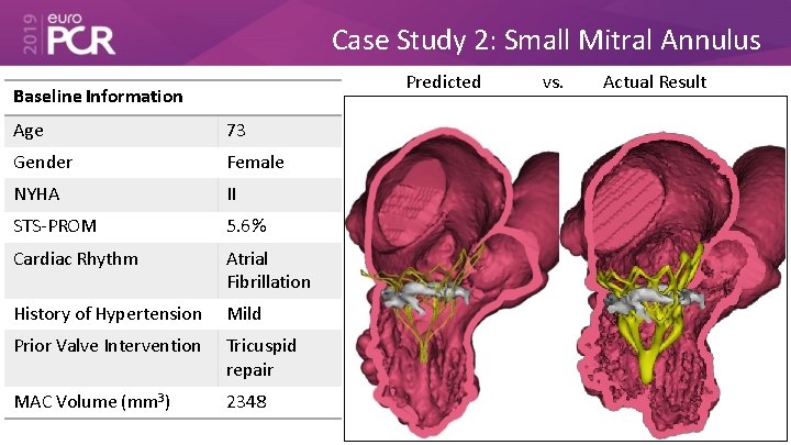 Case Study 2: Small Mitral Annulus Predicted Baseline Information Age 73 Gender Female NYHA