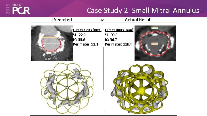 Case Study 2: Small Mitral Annulus Predicted vs. Dimensions (mm) SL: 22. 9 IC: