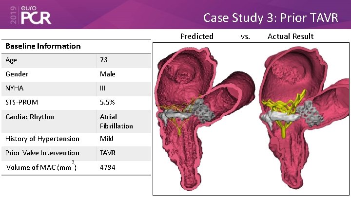 Case Study 3: Prior TAVR Predicted Baseline Information Age 73 Gender Male NYHA III