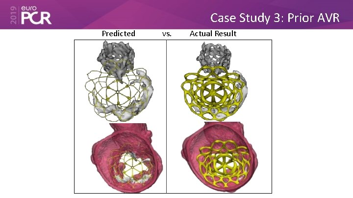 Case Study 3: Prior AVR Predicted vs. Actual Result 