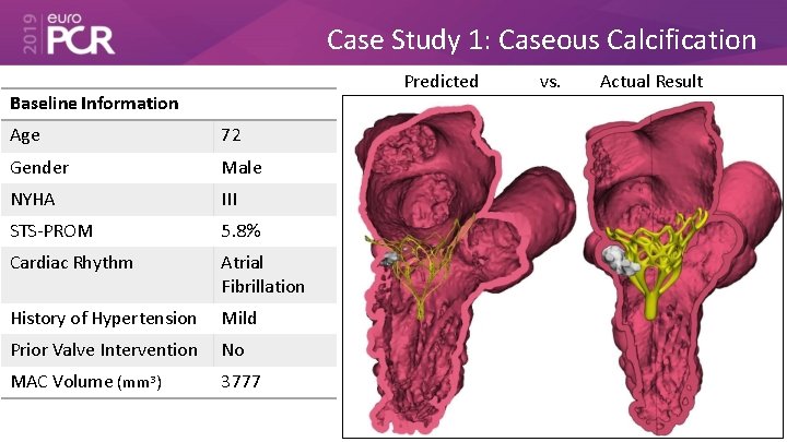 Case Study 1: Caseous Calcification Predicted Baseline Information Age 72 Gender Male NYHA III