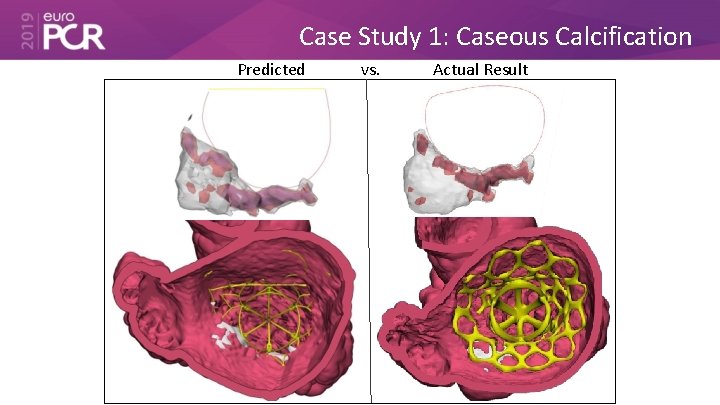 Case Study 1: Caseous Calcification Predicted vs. Actual Result 