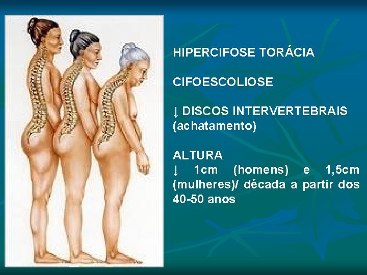 HIPERCIFOSE TORÁCIA CIFOESCOLIOSE ↓ DISCOS INTERVERTEBRAIS (achatamento) ALTURA ↓ 1 cm (homens) e 1, HIPERCIFOSE TORÁCIA CIFOESCOLIOSE ↓ DISCOS INTERVERTEBRAIS (achatamento) ALTURA ↓ 1 cm (homens) e 1,