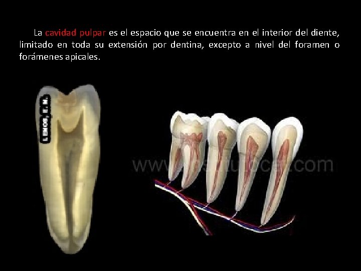 La cavidad pulpar es el espacio que se encuentra en el interior del diente,