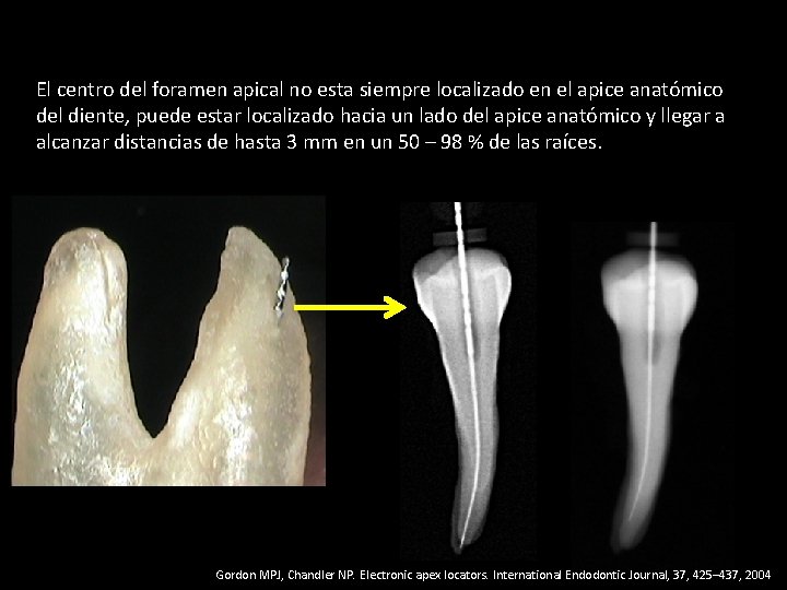 El centro del foramen apical no esta siempre localizado en el apice anatómico del