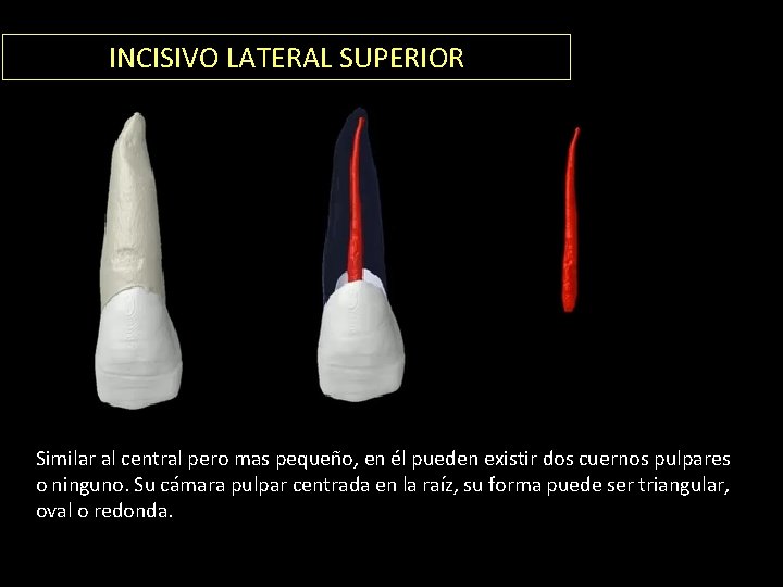 INCISIVO LATERAL SUPERIOR Similar al central pero mas pequeño, en él pueden existir dos