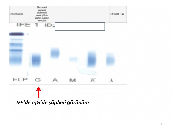 İFE'de Ig. G’de şüpheli görünüm 4 