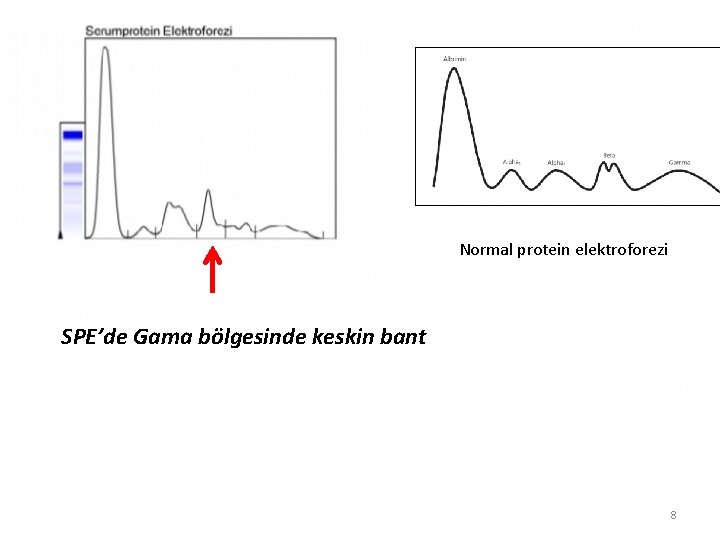 Normal protein elektroforezi SPE’de Gama bölgesinde keskin bant 8 