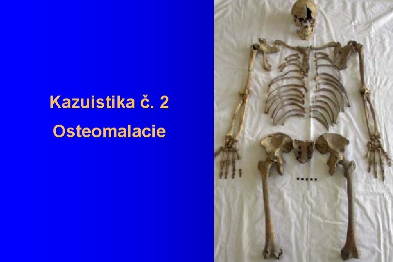 Kazuistika č. 2 Osteomalacie 
