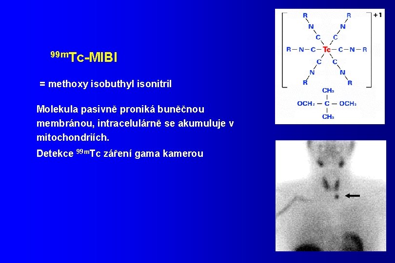 99 m. Tc-MIBI = methoxy isobuthyl isonitril Molekula pasivně proniká buněčnou membránou, intracelulárně se