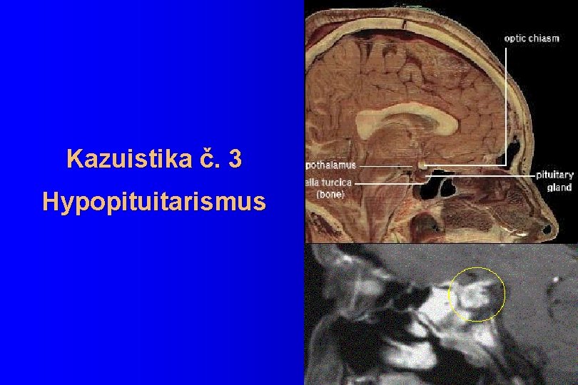 Kazuistika č. 3 Hypopituitarismus 