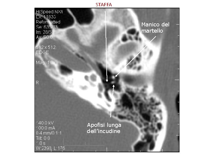 STAFFA Manico del martello Apofisi lunga dell’incudine 